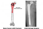 A rare case of limb saving surgery on a septuagenarian at Apollo Cancer Centre, Bangalore